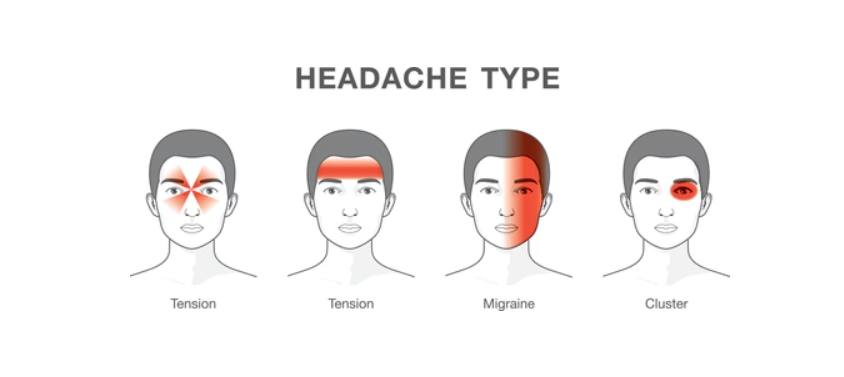The Ultimate Guide to Tension Headaches: Causes, Symptoms, and How Physical Therapy Can Help
